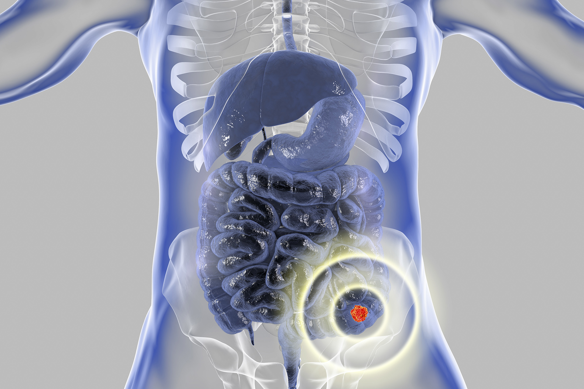 metastatic cancer from colon to liver