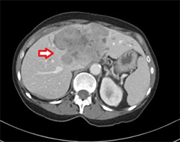 Metastatic Colon and Rectal Cancer to the Liver